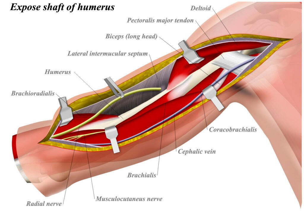 How to Place the Huslcs with Needle Pointed from Anterolateral to Posteromedial.: A Complete Guide